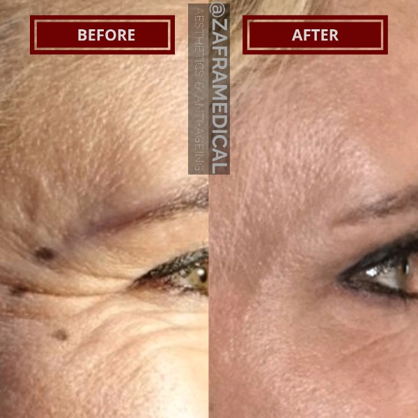 Anti-wrinkle Injections